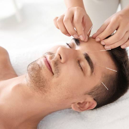 facial acupuncture naturopathic treatment