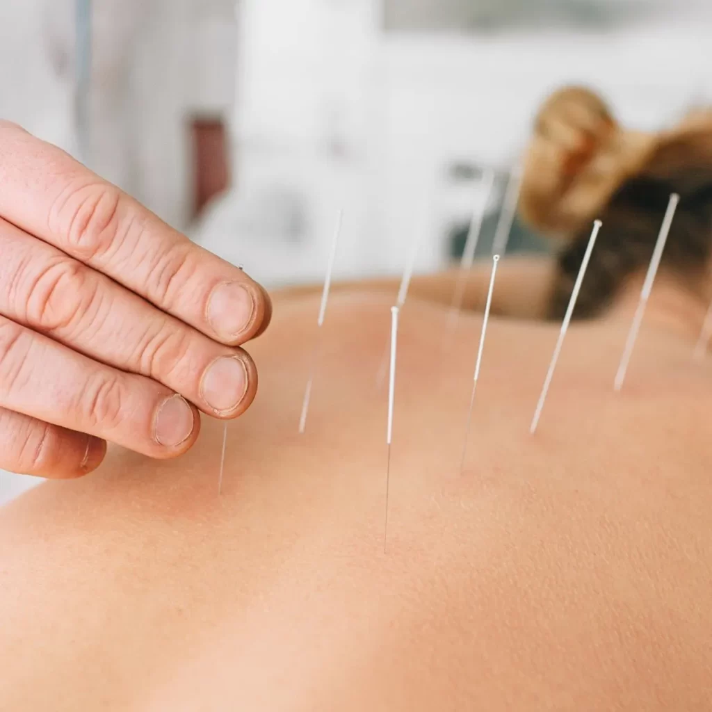 Acupuncture needles inserted into patient with back pain