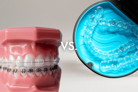 Comparison between Invisalign and braces