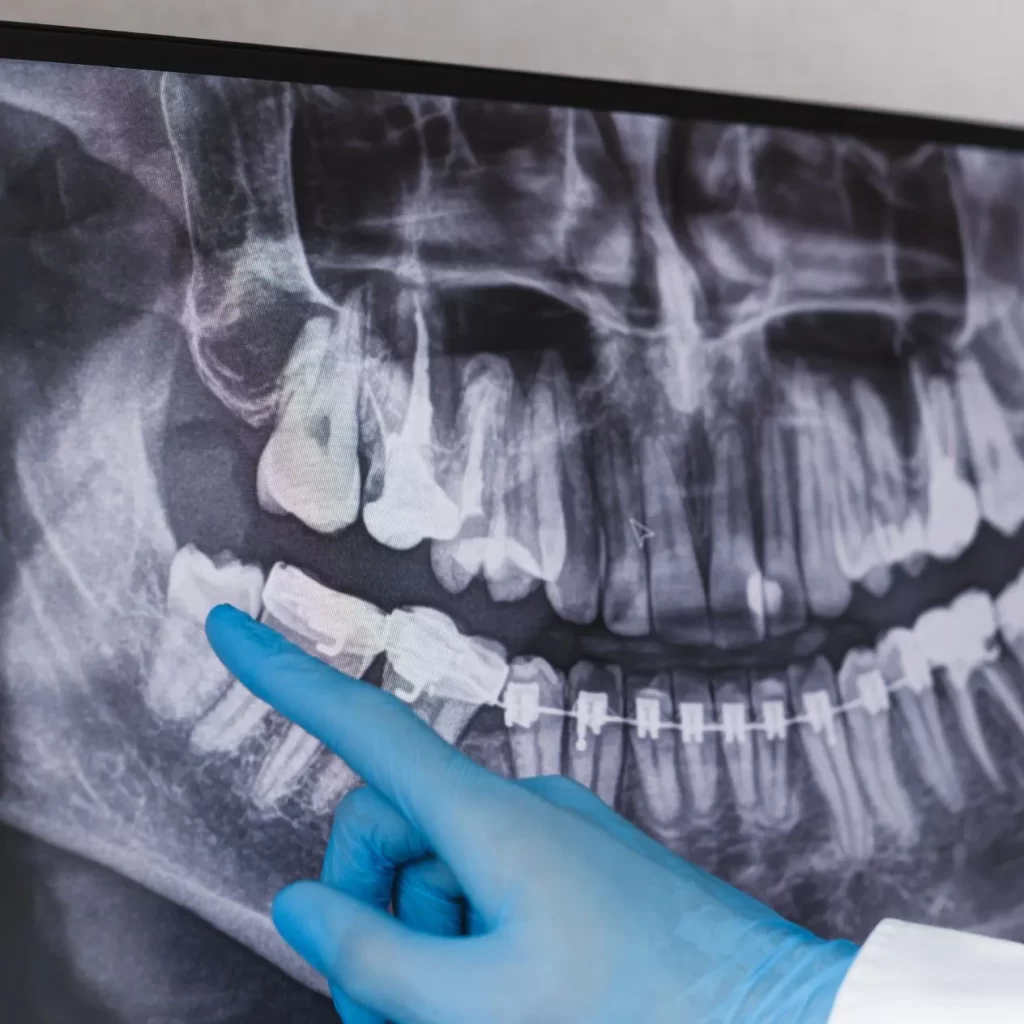 Dentist viewing wisdom teeth removal xray