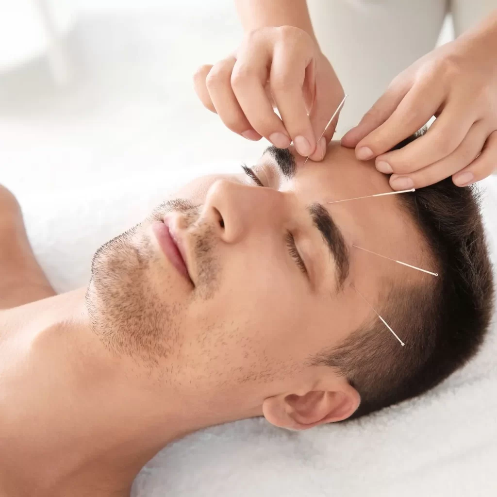 Accupuncture being applied to a man's forehead