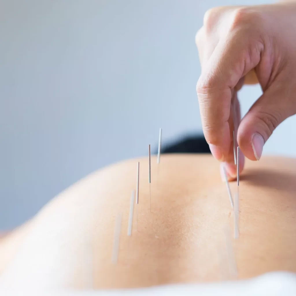 Acupuncture needles inserted into back for pain