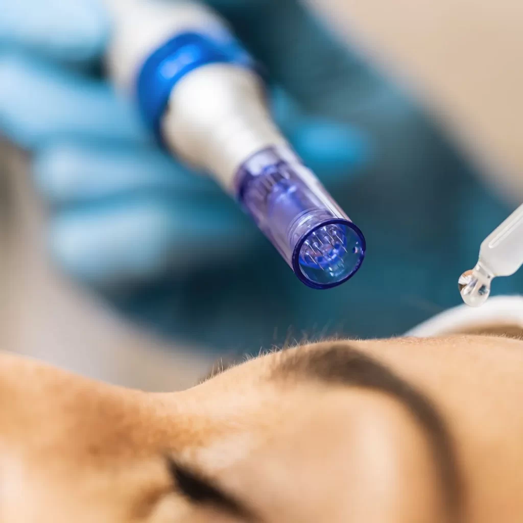 microneedling device being used on skin
