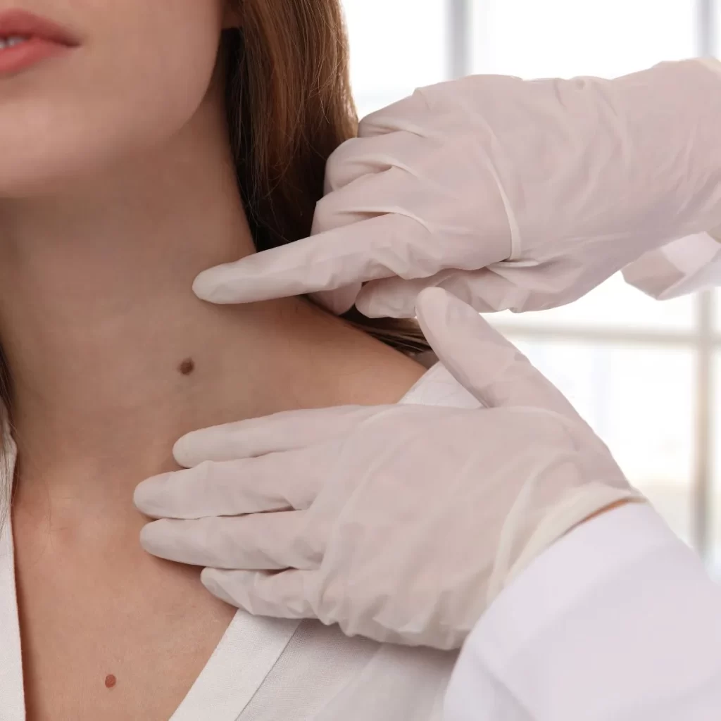 doctor pointing at skin tag before removal