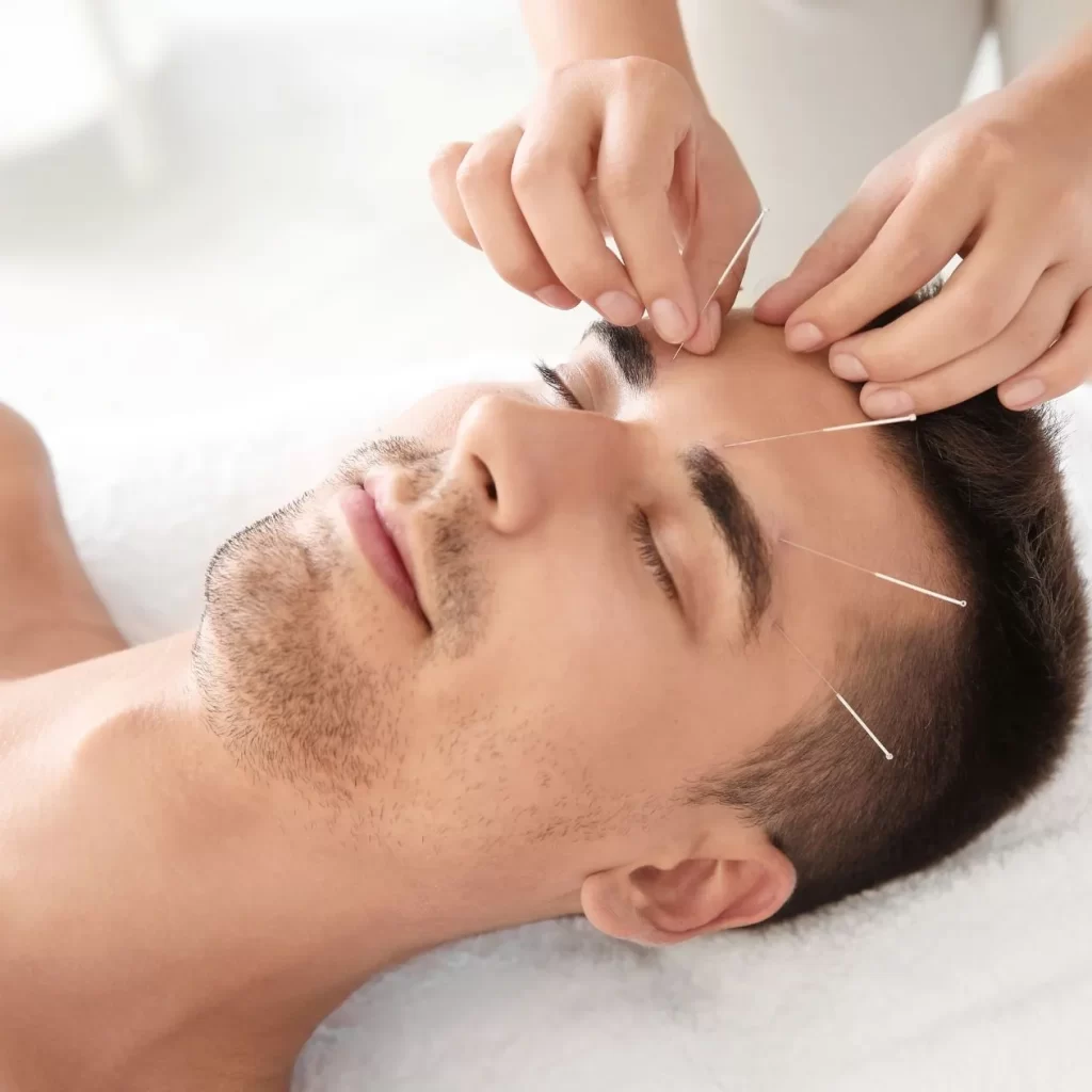 man receiving acupuncture treatment on his forehead