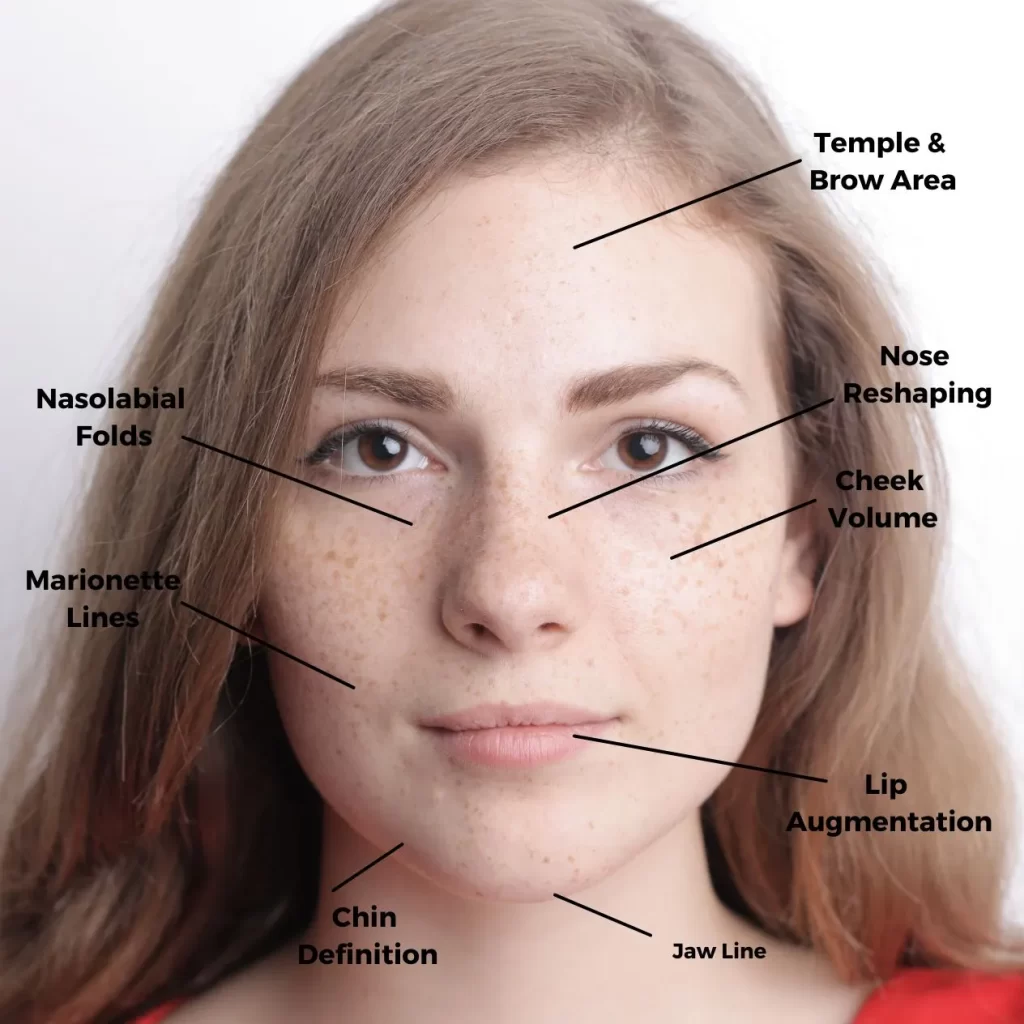 face showing areas injectables can be treated