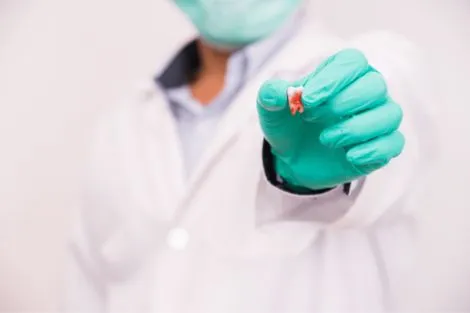 Dentist holding up a single wisdom tooth in his hand