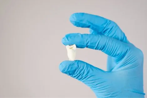 Blue gloved hand holding a wisdom tooth after surgery