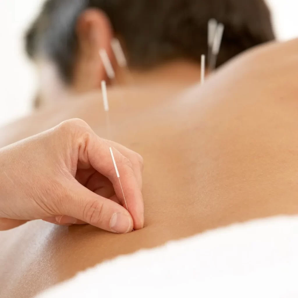 acupuncture needle treatment for back pain