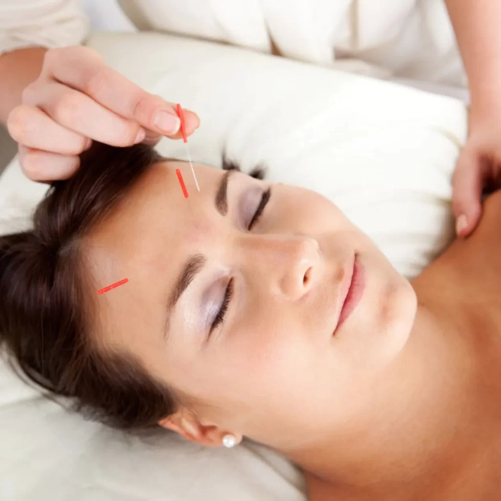 acupuncture service in face