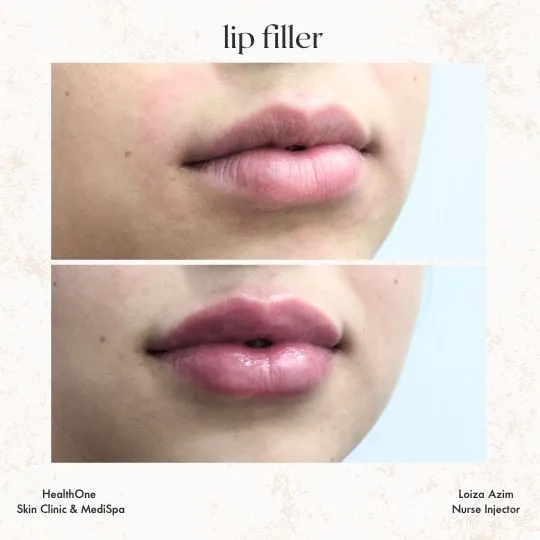 Injectables-Before-and-After-Lip-Filler
