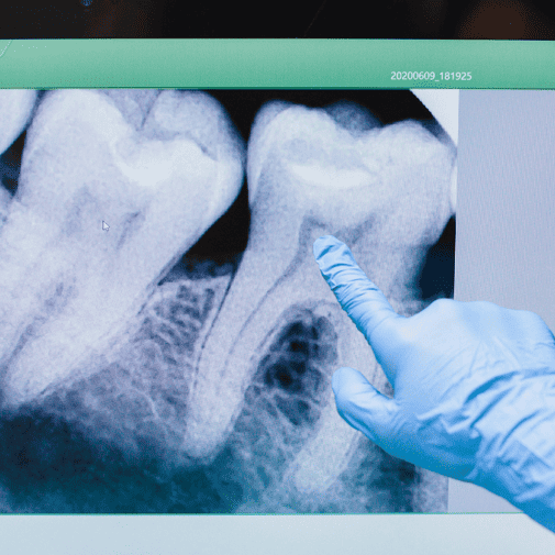 what is root canal explained by dental xray